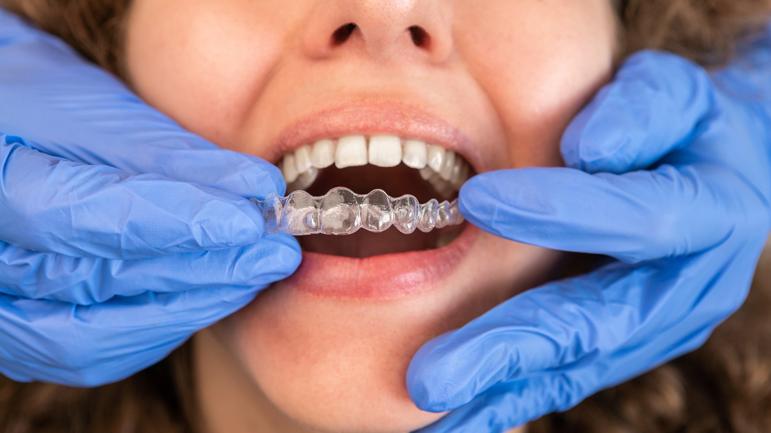 How Invisalign Treatment Works
